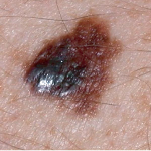 Example Melanoma