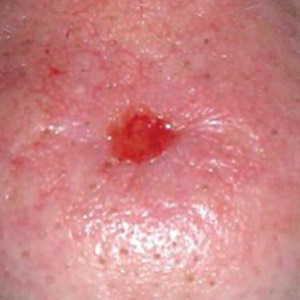 Basal Cell Carcinoma example