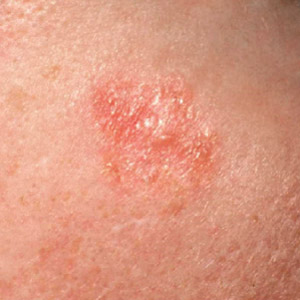 Basal Cell Carcinoma example