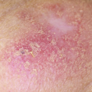 Intra-Epidermal Carcinoma example
