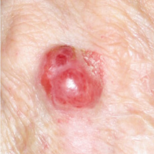 Merkel Cell Carcinoma example