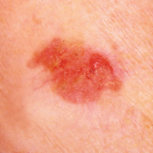 Squamous Cell Carcinoma example