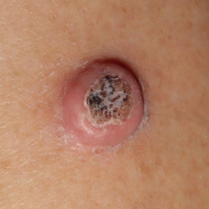 Squamous Cell Carcinoma example